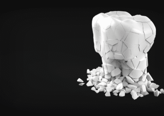 Nuskilo priekinis dantis – kaip greitai jį sutvarkyti?